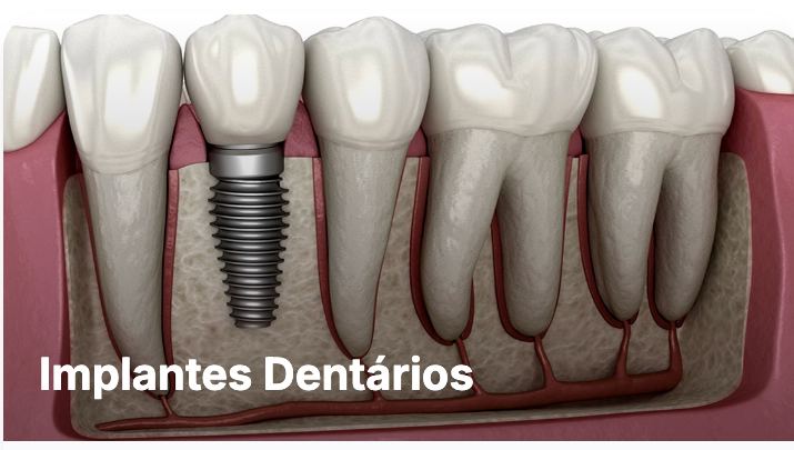Implante dentário em Guarulhos