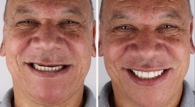 Prótese dentária em Guarulhos — antes e depois